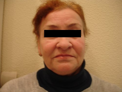 Отек на лбу между бровей Отек на лбу между бровей