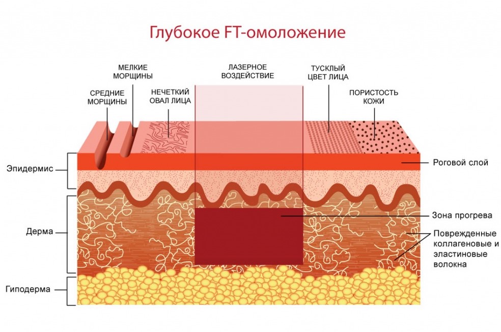 Лазерный термолифтинг