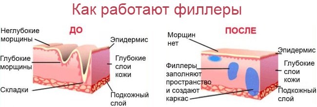 Контурная пластика филлерами гиалуроновой кислоты