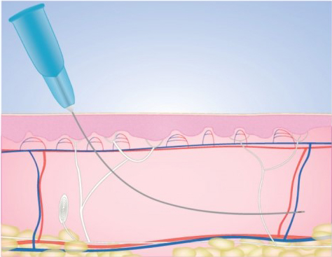Контурная пластика филлерами гиалуроновой кислоты