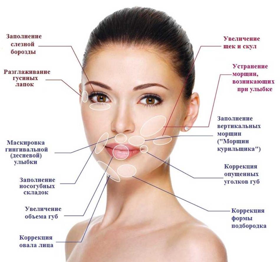Контурная пластика филлерами гиалуроновой кислоты