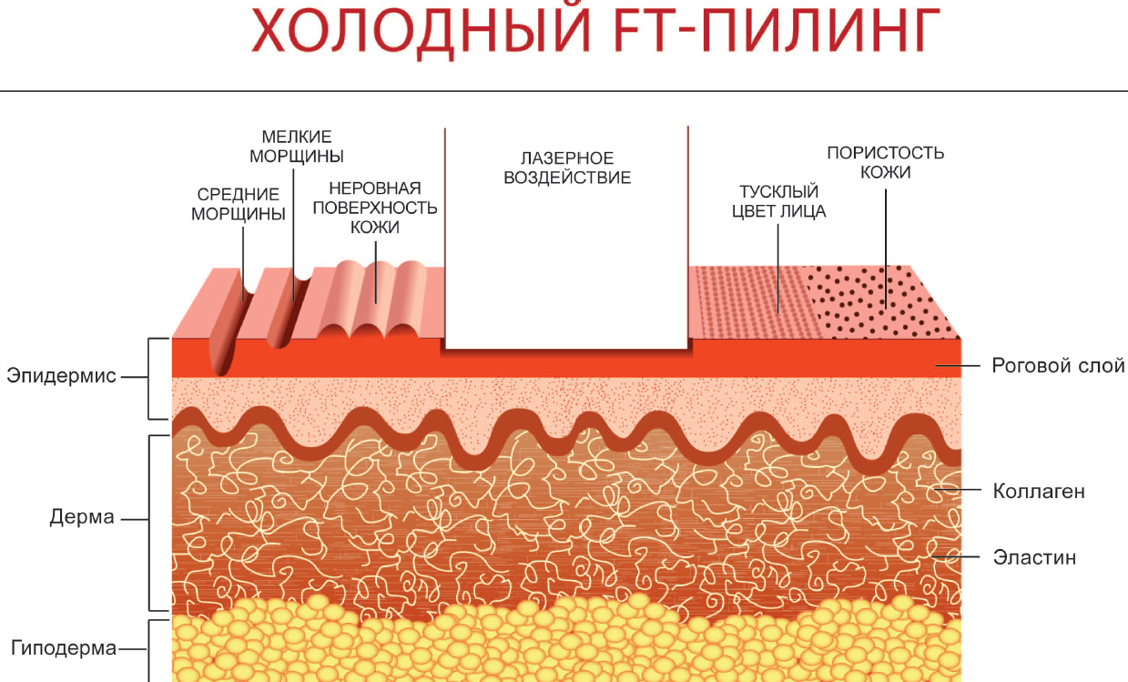 Лазерное омоложение лица