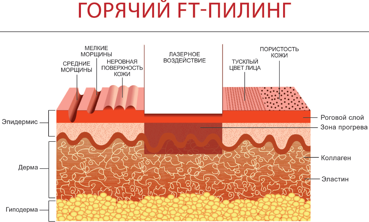 Горячий пилинг кожи КосметоМед