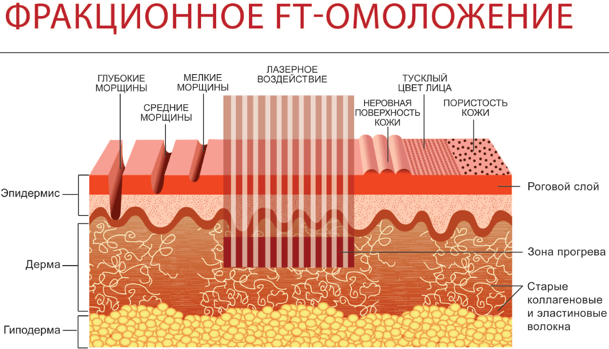 Лазерное фракционное омоложение кожи