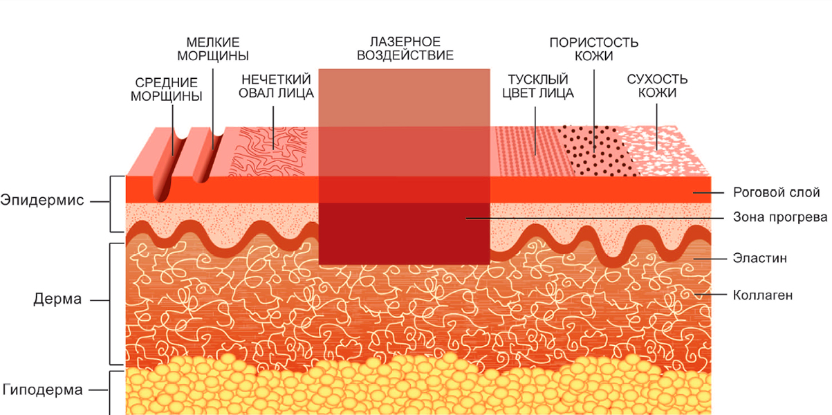 SMOOS–омоложение FOTONA SMOOS