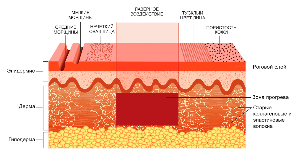 ЛАЗЕРНЫЙ ТЕРМОЛИФТИНГ