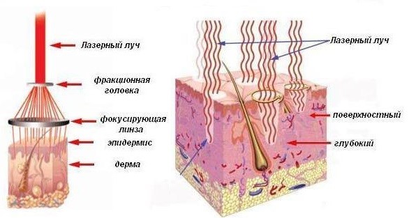 Фракционное неаблятивное лазерное омоложение