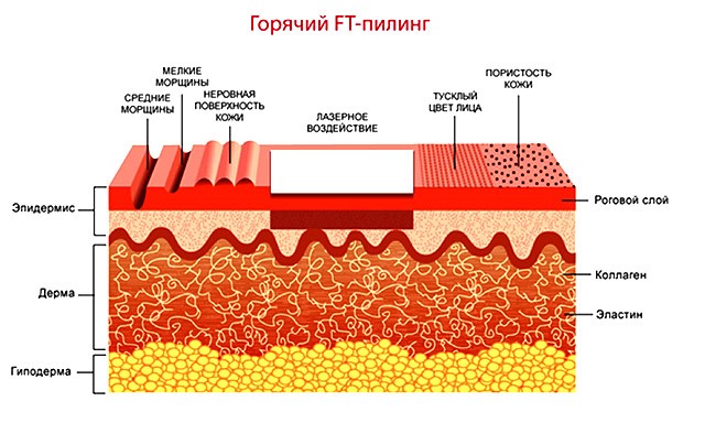 Горячий лазерный пилинг