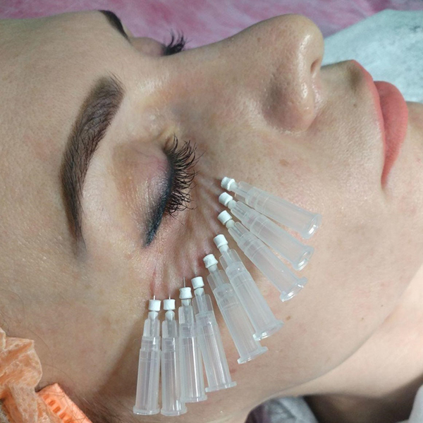 Тредлифтинг мезонитями - подтяжка и коррекция лица мезонитями.