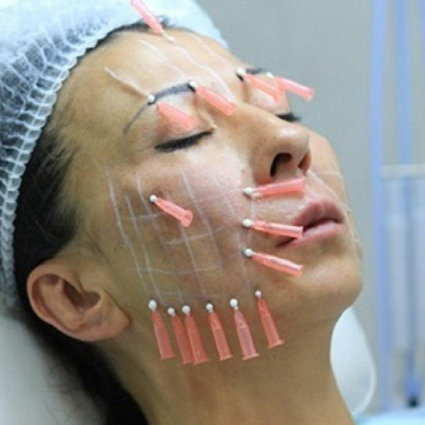 Тредлифтинг мезонитями - подтяжка и коррекция лица мезонитями.