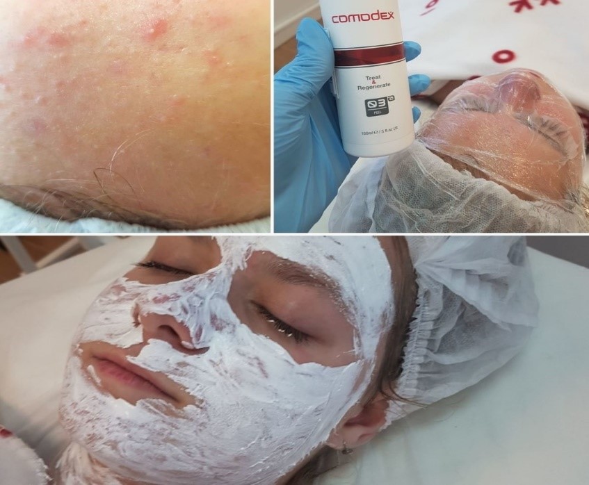 Ручная механическая чистка лица