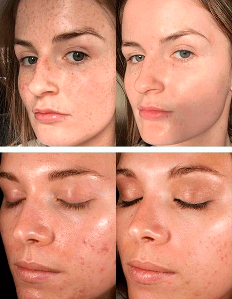 Пилинг PRX T33