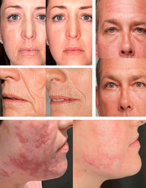 Пилинг PRX T33