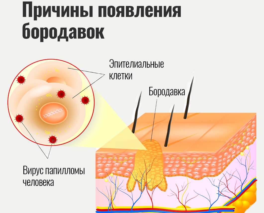 Бородавки причины