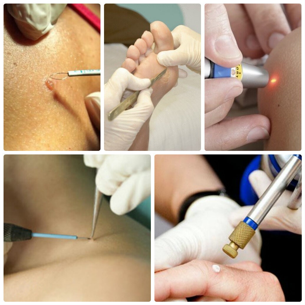 Удаление новообразований кожи лазером