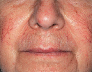 Удаление сосудистых звездочек (сосудов, капилляров) лазером до и после