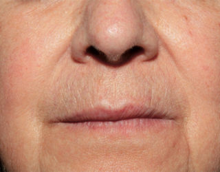 Удаление сосудистых звездочек (сосудов, капилляров) лазером до и после