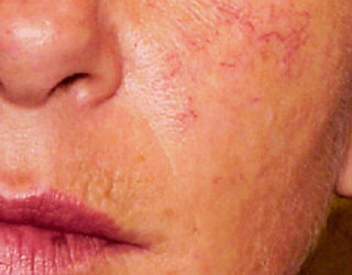 Удаление сосудистых звездочек (сосудов, капилляров) лазером до и после