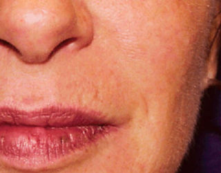 Удаление сосудистых звездочек (сосудов, капилляров) лазером до и после