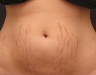 Удаление растяжек лазером до и после