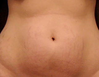 Удаление растяжек лазером до и после