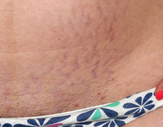 Удаление растяжек лазером до и после