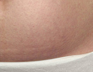 Удаление растяжек лазером до и после