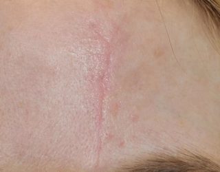 Удаление рубцов и шрамов лазером до и после