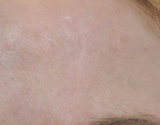 Удаление рубцов и шрамов лазером до и после