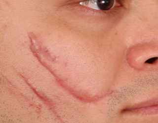 Удаление рубцов и шрамов лазером до и после