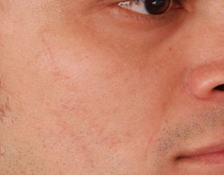 Удаление рубцов и шрамов лазером до и после