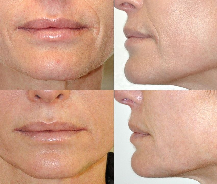 Результаты и гарантии 4D-омоложения До и После