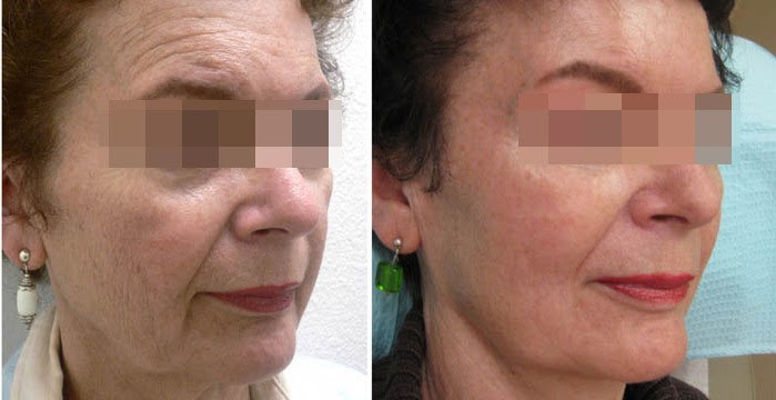 Результаты и гарантии 4D-омоложения До и После