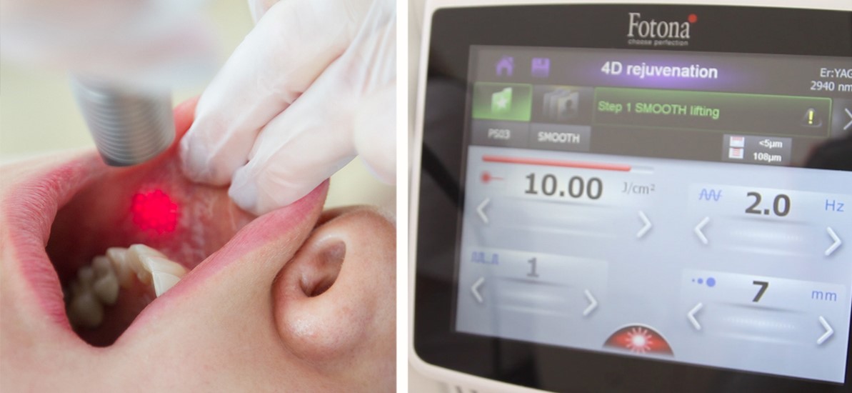 Как проводится 4D омоложение Fotona Процесс