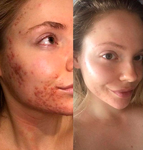 Лечение акне лазером