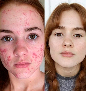 Лечение акне лазером