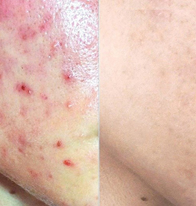 Лечение акне лазером