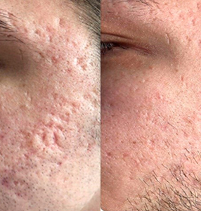 Лечение акне лазером