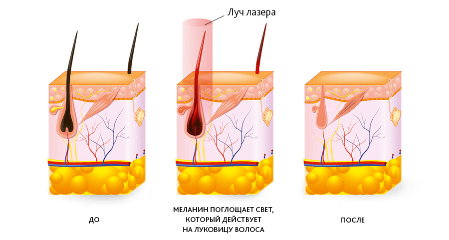 Суть метода удаления волос диодным лазером