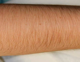 Лазерная эпиляция рук