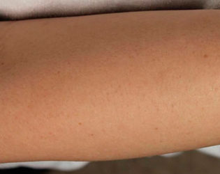 Лазерная эпиляция рук