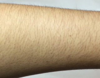 Лазерная эпиляция рук