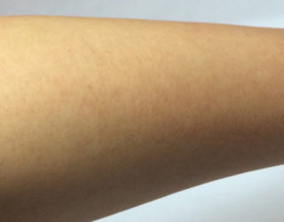 Лазерная эпиляция рук