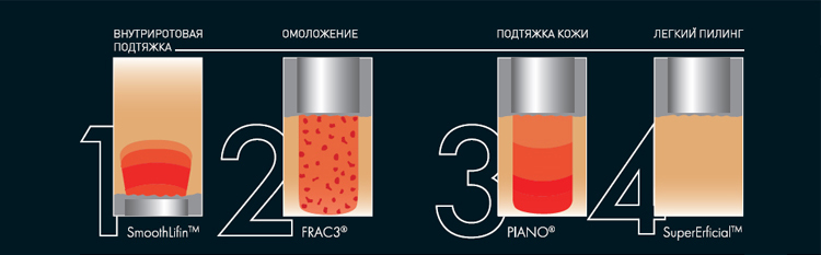 Как проводится 4D омоложение Fotona Процесс