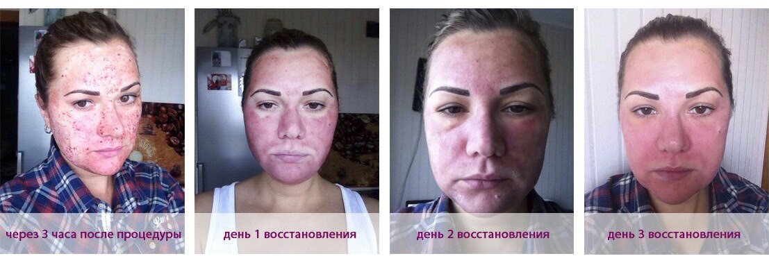 Лазерная шлифовка осстановительный период и результат