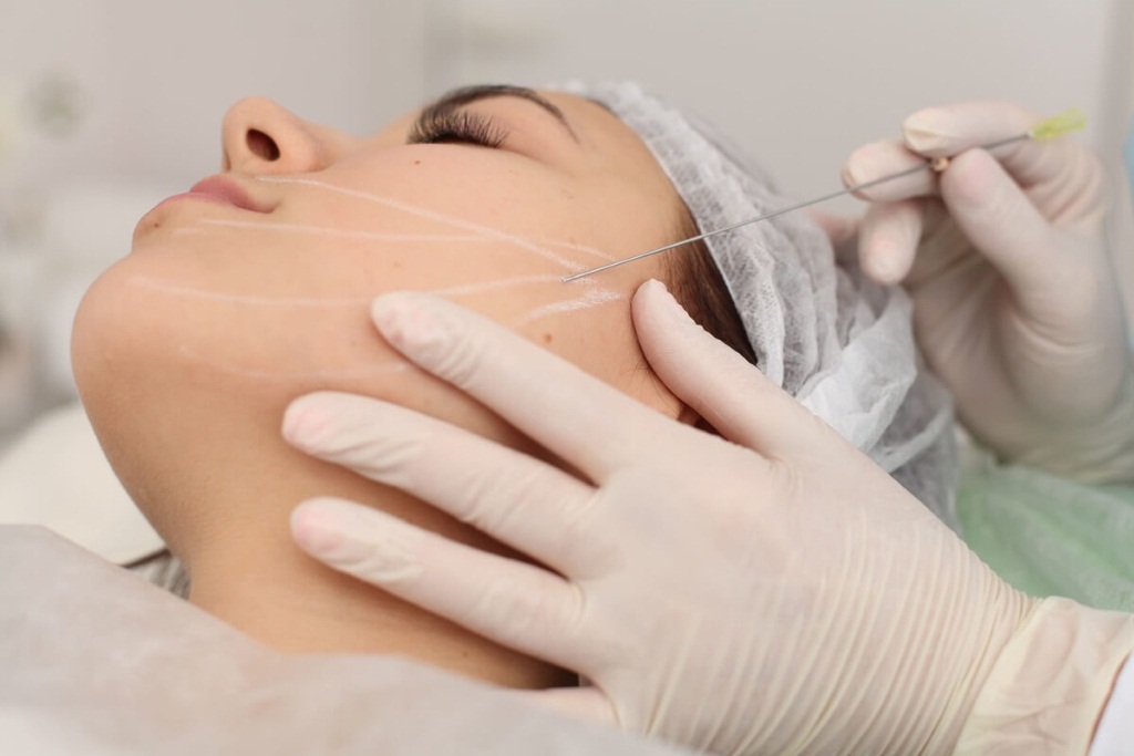 Нитевой лифтинг лица