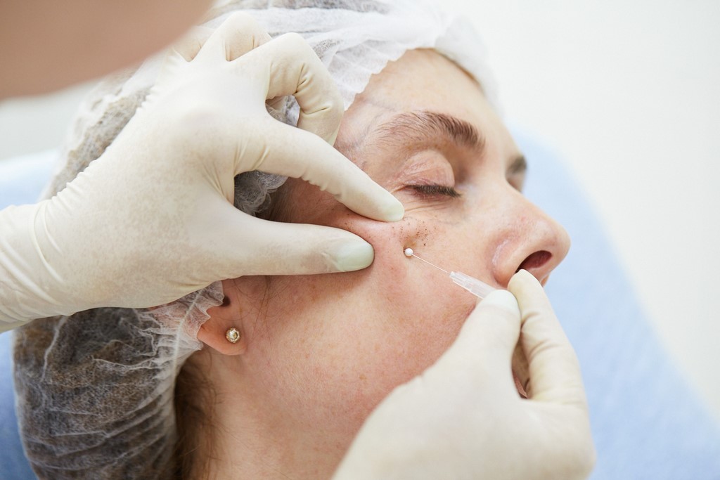 Нитевой лифтинг лица